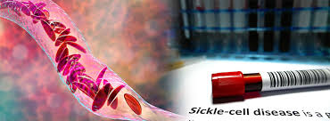 Sickle Cell Disease Treatment in India