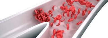 Anemia Treatment in India